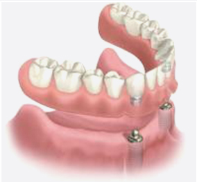 Implant-retained-denture