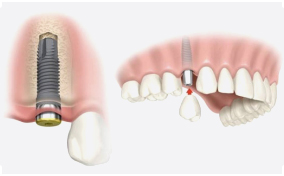 Single-teeth-implants