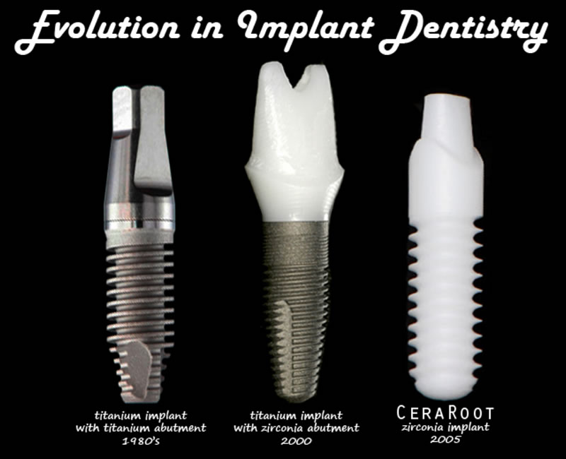 Dental Implants