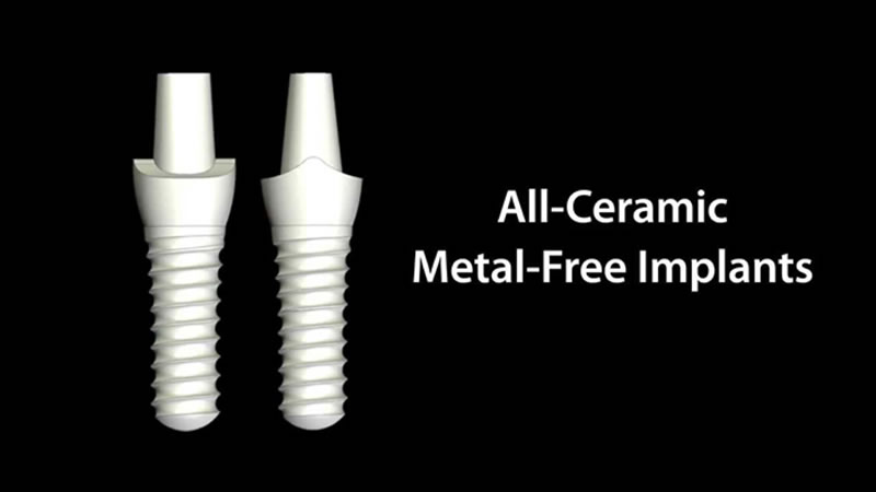 Dental Implants