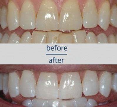 Teeth Whitening zoompic-before-and-after-dr-snider-margolian